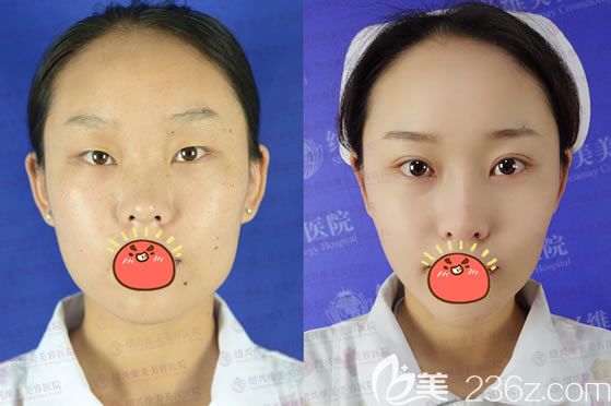 紹興維美韓興斌割雙眼皮開眼角案例