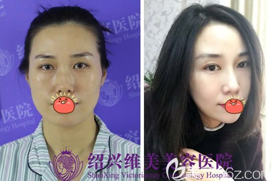 紹興維美<!--<i data=20240703-sp></i>-->輝鼻綜合隆鼻案例