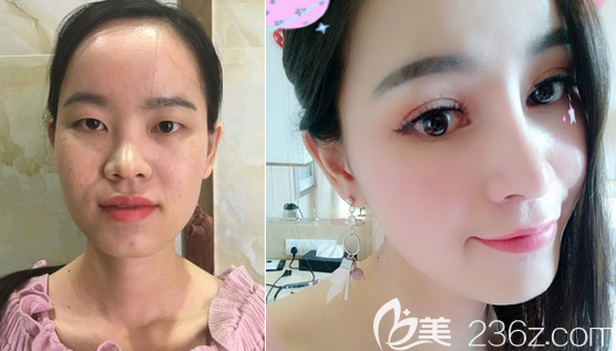 <i data-id='ba539b48-3594-4a53-8490-815aedab2ab5' ></li>
?
<li><i data-id='ba539b48-3594-4a53-8490-815aedab2ab5' style='display:none;'></i>茍磊鼻綜合案例