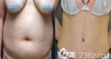 韓國(guó)德社羅伊徐云泳吸脂真人案例