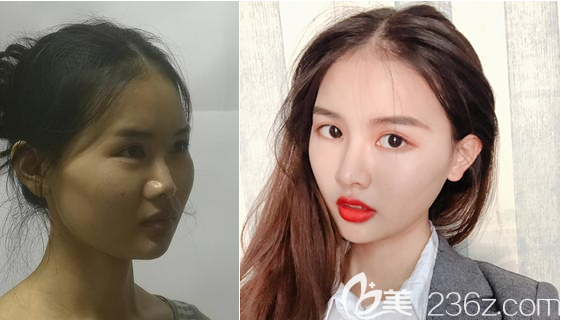 南充阿藍(lán)整形<!--<i data=20240703-sp></li>
?
<li><i data=20240703-sp></i>-->鼻綜合案例