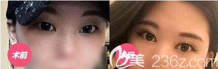 南充五星整形美容醫(yī)院雙眼皮開眼角案例 南充五星整形美容醫(yī)院雙眼皮開眼角案例