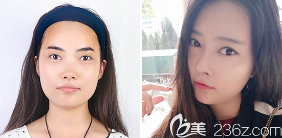 南充韓美整形醫(yī)院自體脂肪面部填充案例 南充韓美整形醫(yī)院自體脂肪面部填充案例