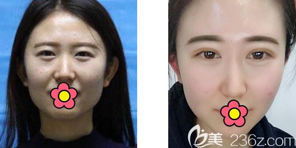 包頭華美王金紅主任全切雙眼皮+玻尿酸墊下巴案例