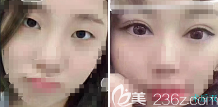 南充華美名媛整形醫(yī)院雙眼皮案例 南充華美名媛整形醫(yī)院雙眼皮案例