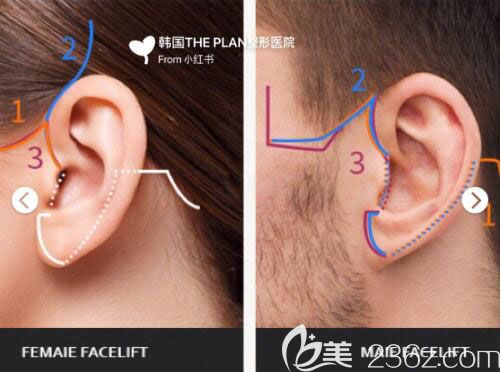 韓國The Plan整形外科醫(yī)院根據男女不同的輪廓結構定制手術方法