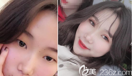 <i data-id='afaee8e0-ea4b-4fb9-a3bc-de6c9bbac51f' ></li>
?
<li><i data-id='afaee8e0-ea4b-4fb9-a3bc-de6c9bbac51f' style='display:none;'></i>整形宋日強(qiáng)雙眼皮案例