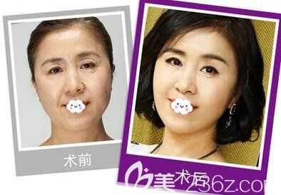 韓版案例前后效果對比圖