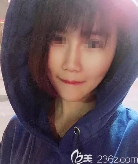 到常州曙光做項(xiàng)目納米脂肪全面部精雕，術(shù)后從喪氣臉到少女顏皮膚也變好了