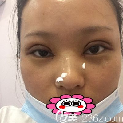 術(shù)后第8天，剛拆過線的照片