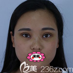 雙眼皮手術(shù)20天恢復(fù)圖