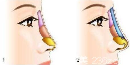 隆鼻取出假體后鼻子跟以前一樣嗎？