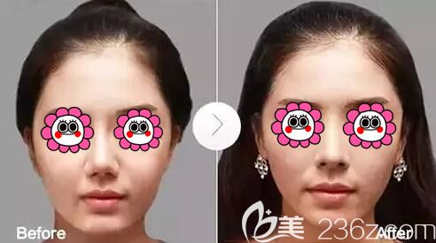 隆鼻假體取出真人案例對比