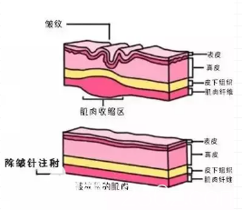 除皺針注射的位置