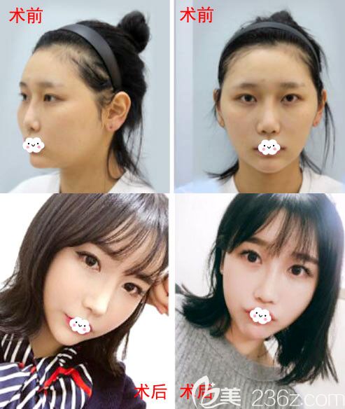 韓國臉本臉骨整形醫(yī)院面部輪廓整形正面?zhèn)让媲昂笮Ч麑Ρ葓D