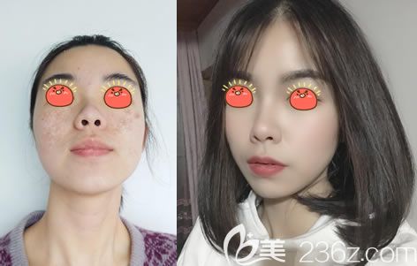 紹興維美整形岳輝做激光祛斑案例 紹興維美整形岳輝做激光祛斑案例