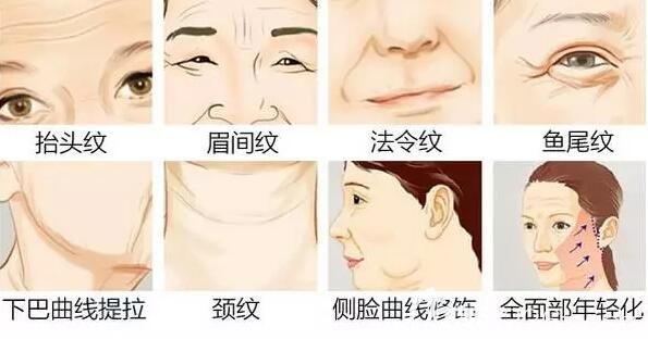 埋線提升可以改善的皮膚狀態(tài) 埋線提升可以改善的皮膚狀態(tài)