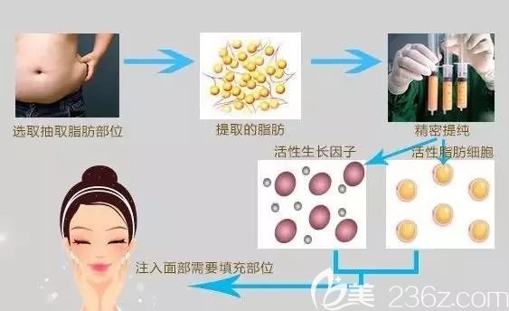 李冬醫(yī)生分享自體脂肪填充原理 李冬醫(yī)生分享自體脂肪填充原理