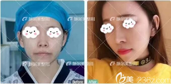 找李冬醫(yī)生做脂肪填充全面部對(duì)比案例 找李冬醫(yī)生做脂肪填充全面部對(duì)比案例