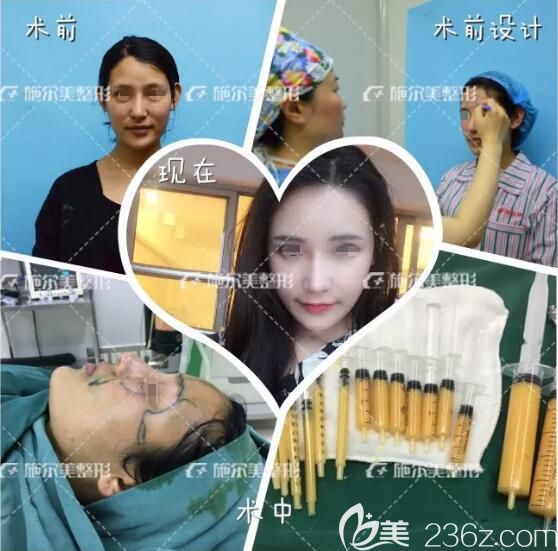 到常州施爾美做脂肪填充全過程 到常州施爾美做脂肪填充全過程