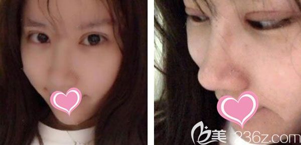 肋軟骨假體隆鼻第7天鼻小柱和鼻孔里的線都拆掉了 肋軟骨假體隆鼻第7天鼻小柱和鼻孔里的線都拆掉了