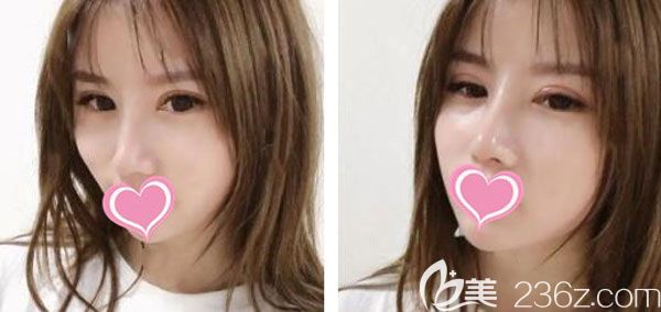 隆鼻術后第20天山根和鼻頭都不腫了 隆鼻術后第20天山根和鼻頭都不腫了