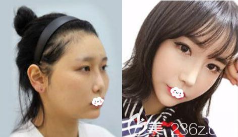 韓國醫(yī)生樸用男顴骨降低整形案例效果前后對比圖