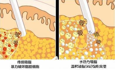 負(fù)壓吸脂詳情介紹