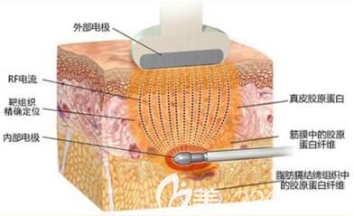 激光溶脂作用功能詳細(xì)介紹