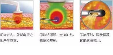 射頻溶脂功能作用介紹