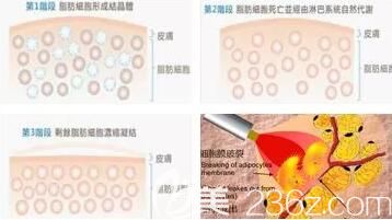 冷凍溶脂作用極其詳情介紹說明