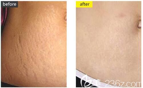 石雪冰醫(yī)生去妊娠紋前后對(duì)比 石雪冰醫(yī)生去妊娠紋前后對(duì)比