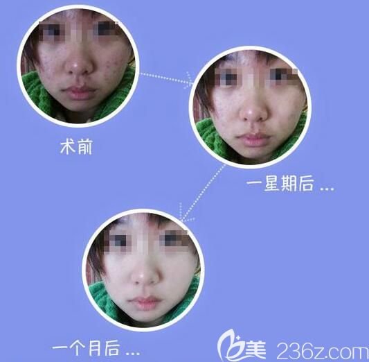 <!--<i data=20240703-sp></i>-->主任祛痘案例分享 <!--<i data=20240703-sp></i>-->主任祛痘案例分享