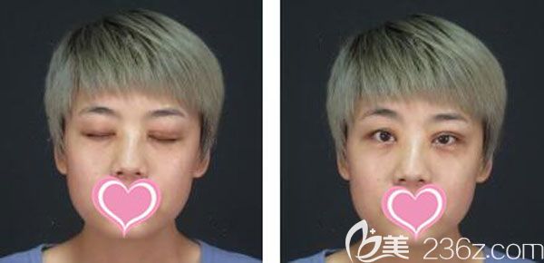 在昆明美伊萊整形割雙眼皮前 在昆明美伊萊整形割雙眼皮前