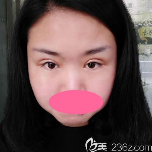 西寧康華醫(yī)院彭書強(qiáng)院長給我做全切雙眼皮術(shù)后第4天效果