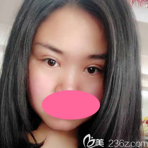 西寧康華醫(yī)院彭書強(qiáng)院長給我做全切雙眼皮術(shù)后第15天效果