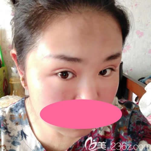 西寧康華醫(yī)院給我做全切雙眼皮40天后 朋友都說恢復(fù)的很自然