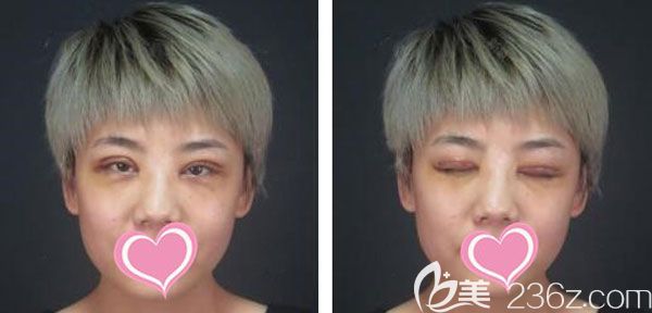 切開雙眼皮第7天眼睛線條流暢 切開雙眼皮第7天眼睛線條流暢