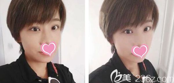 全切雙眼皮第20天腫脹和淤青已經(jīng)消退 全切雙眼皮第20天腫脹和淤青已經(jīng)消退