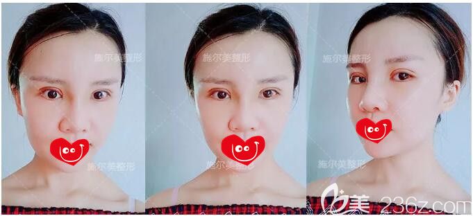 一周拆線眼鼻恢復(fù)中