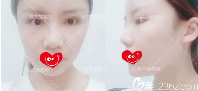 術(shù)后15天到常州施爾美做整形恢復(fù)情況