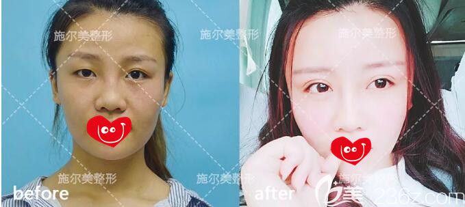 一單一雙不對稱的小眼睛外加肥大的鼻頭找常州施爾美醫(yī)生做了眼鼻綜合外加自體脂肪豐額頭蛻變記