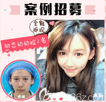 注射玻尿酸案例