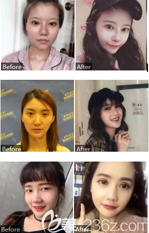 玻尿酸注射案例