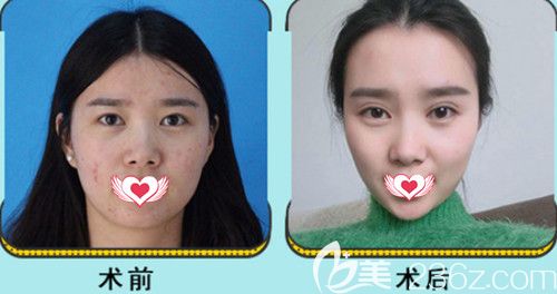 京美整形醫(yī)院注射瘦臉案例