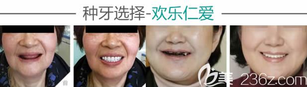 沈陽歡樂口腔全口種植牙案例效果圖