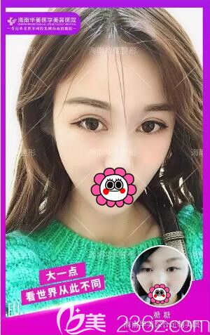 海南華美雙眼皮真人案例前后效果展示