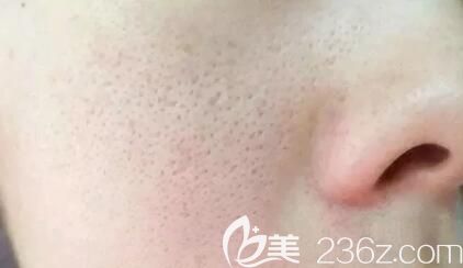海南紅妝雙美介紹毛孔粗大怎么辦？