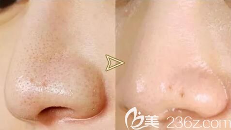 海南紅妝雙美清O毛孔法真人前后效果對比