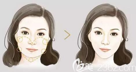 下頜角整形前后效果對(duì)比